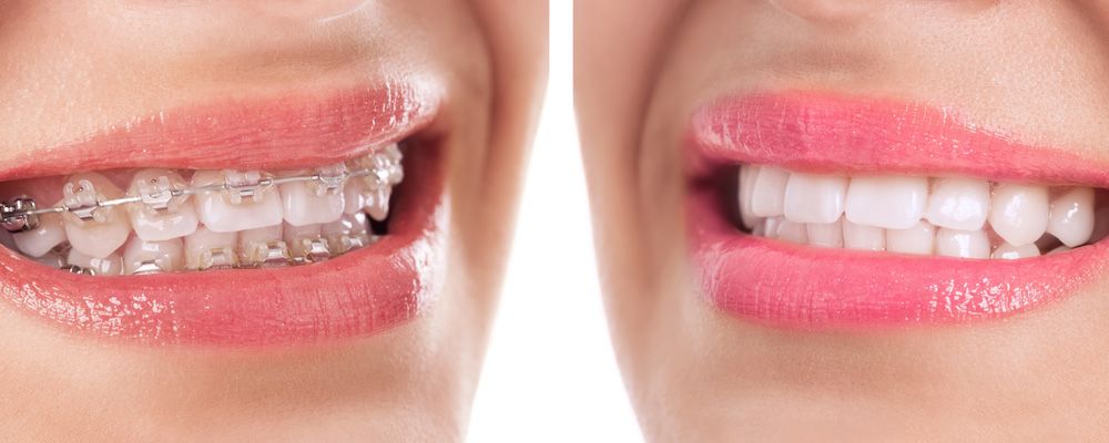 Quelle mutuelle pour orthodontie adulte ?
